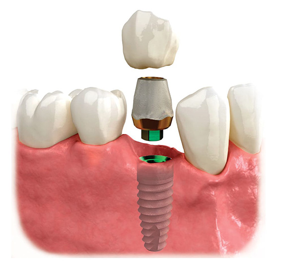 High-quality Dental Implants in Las Vegas, NV